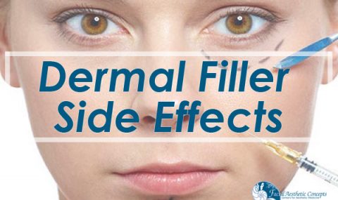 What are the side effects of dermal fillers?