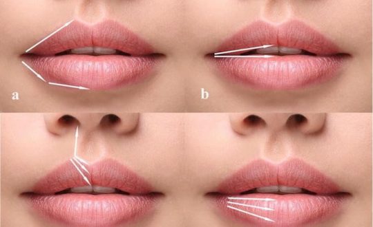 How long do fillers lips last?